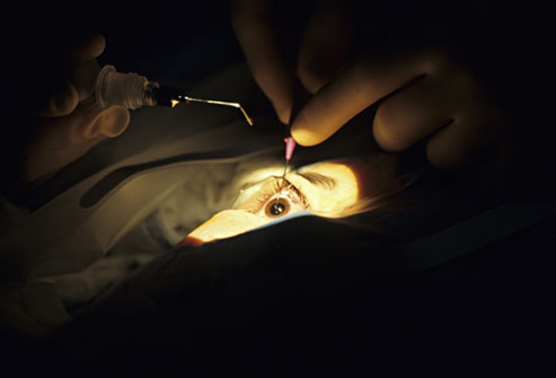 cataract8