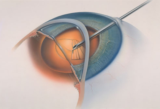 cataract8b
