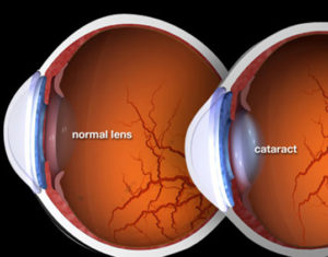 Eye Care Cataract Major Opticians Waterford Ireland South East