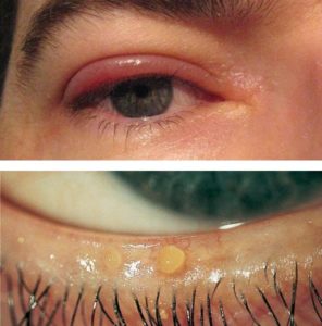 Blepharitis