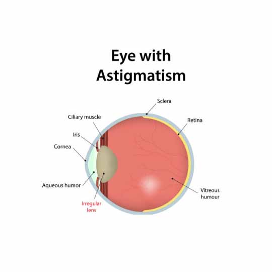 astigmatism