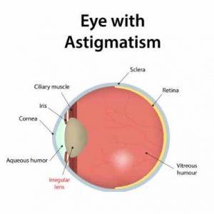 astigmatism